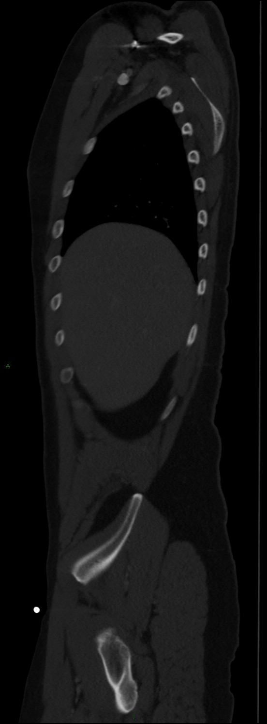 Burst fracture (Radiopaedia 83168-97542 Sagittal bone window 34).jpg
