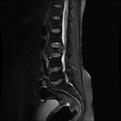 File:Burst fracture - lumbar spine (Radiopaedia 72877-83541 Sagittal STIR 4).jpg