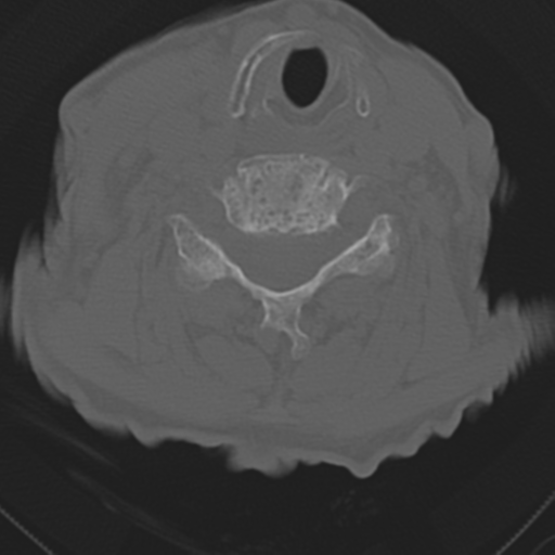 File:C2 fracture with vertebral artery dissection (Radiopaedia 37378-39199 Axial bone window 34).png