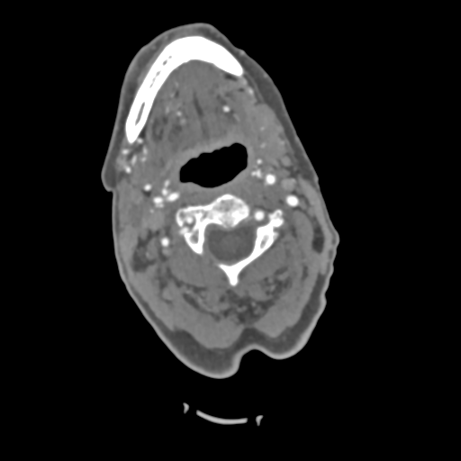 C2 fracture with vertebral artery dissection (Radiopaedia 37378-39200 A 159).png