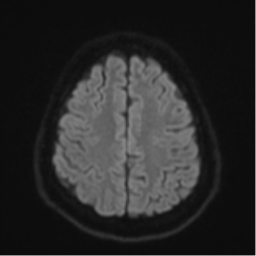File:CNS vasculitis (Radiopaedia 55715-62263 Axial DWI 52).png