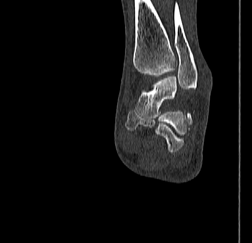Calcaneal fracture - Sanders type 4 (Radiopaedia 90179-107370 Coronal bone window 60).jpg