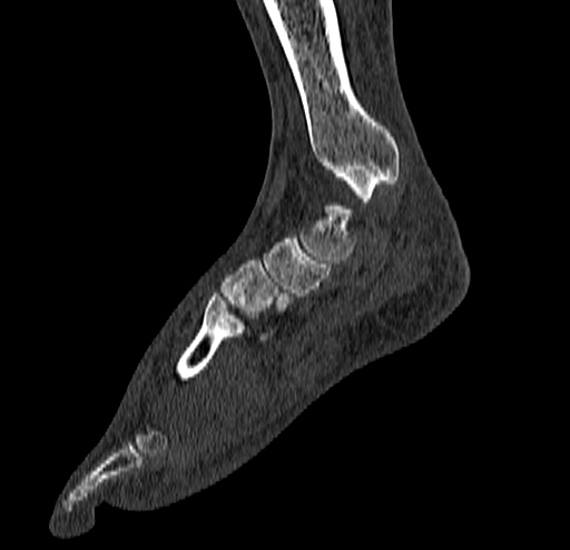 File:Calcaneal fracture - Sanders type 4 (Radiopaedia 90179-107370 Sagittal bone window 36).jpg