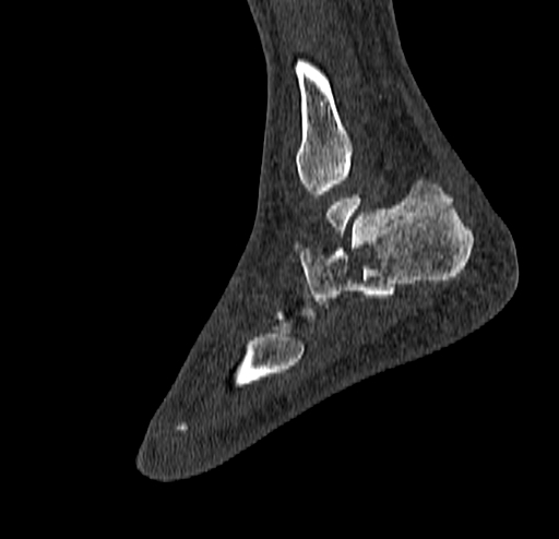 Calcaneal fracture - Sanders type 4 (Radiopaedia 90179-107370 Sagittal bone window 66).jpg