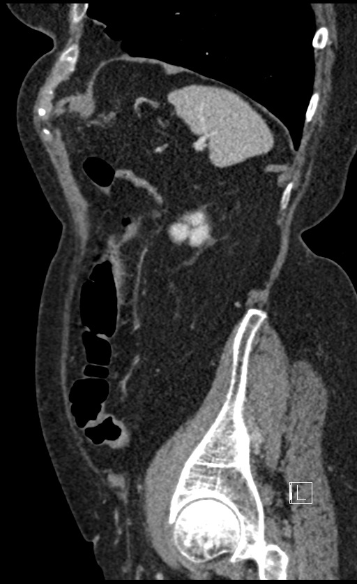 Calcified adrenal glands and Spigelian hernia (Radiopaedia 49741-54988 C 33).jpg