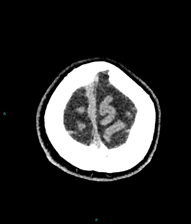 Calcified cerebral emboli from left ventricular thrombus (Radiopaedia 84420-99758 Axial non-contrast 10).jpg