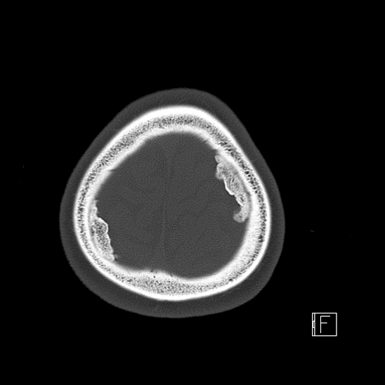Calcified chronic subdural hematoma (Radiopaedia 77374-89492 Axial bone window 126).jpg
