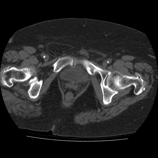 File:Calcified fibroids (Radiopaedia 16853-16579 non-contrast 16).jpg