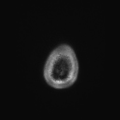 Callosal dysgenesis with interhemispheric cyst (Radiopaedia 53355-59335 Axial T1 158).jpg