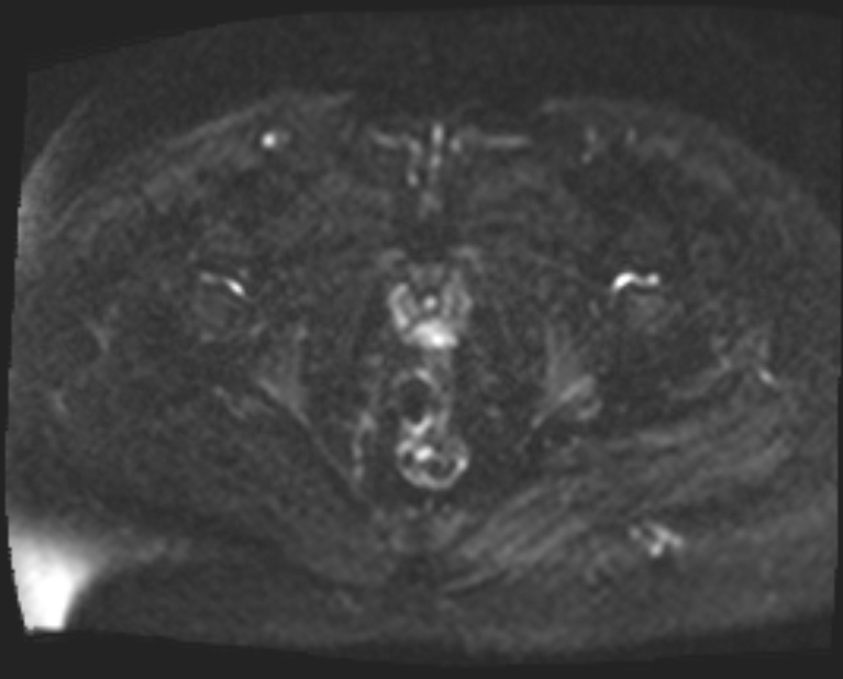 Cancer cervix - stage IIb (Radiopaedia 75411-86615 Axial DWI 34).jpg