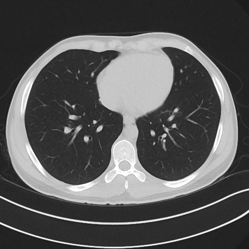 File:Cannabis ('bong') smoking induced pneumomediastinum and subcutaneous emphysema (Radiopaedia 29947-30479 C 54).jpg