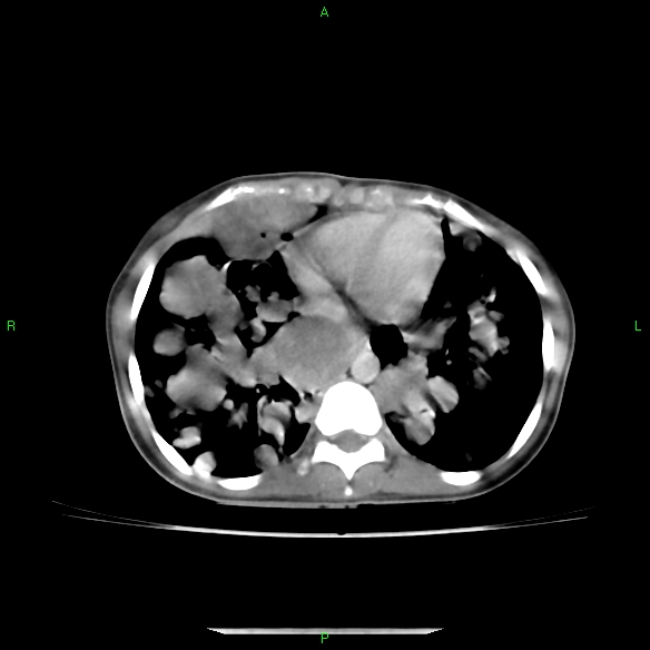 File:Cannon ball metastases - synovial sarcoma (Radiopaedia 26135-26271 C 26).jpg