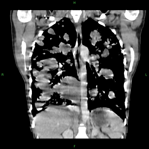 File:Cannon ball metastases - synovial sarcoma (Radiopaedia 26135-26271 Coronal liver window 11).jpg