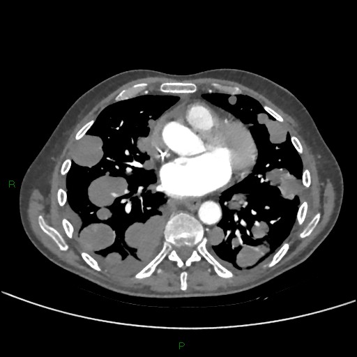 Cannonball metastases (Radiopaedia 82110-96150 Axial C+ CTPA 195).jpg