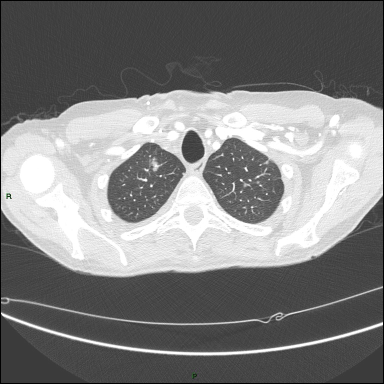 Cannonball metastases (Radiopaedia 82110-96150 Axial lung window 37).jpg