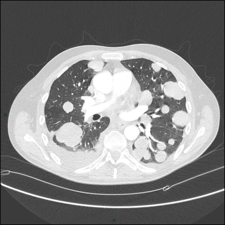 Cannonball metastases (Radiopaedia 82110-96150 Axial lung window 99).jpg