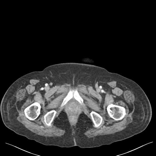 Cannonball metastases from endometrial cancer (Radiopaedia 42003-45031 E 79).png