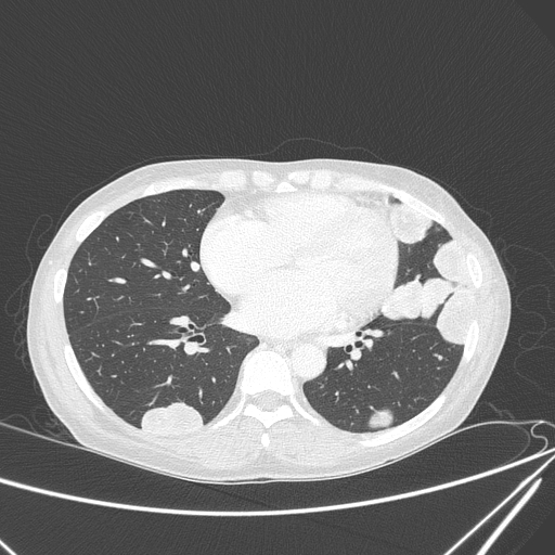 Canonball lung metastasis (Radiopaedia 77634-89837 Axial lung window 111).jpg