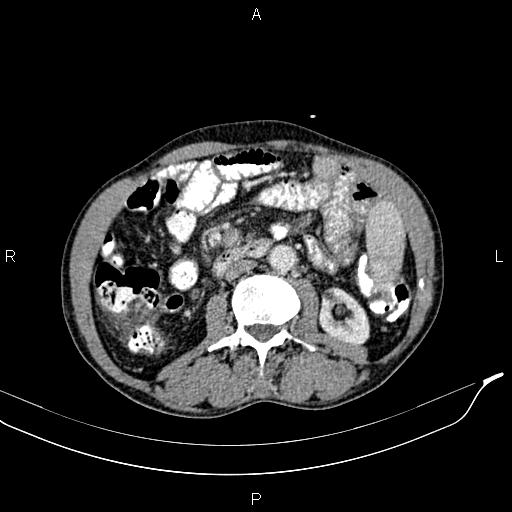 Caput medusae sign - portal hypertension (Radiopaedia 64007-72759 A 45).jpg