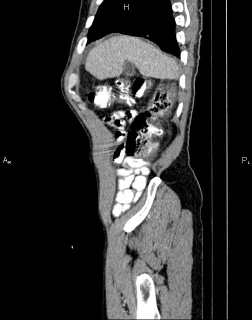 Caput medusae sign - portal hypertension (Radiopaedia 64007-72759 B 4).jpg