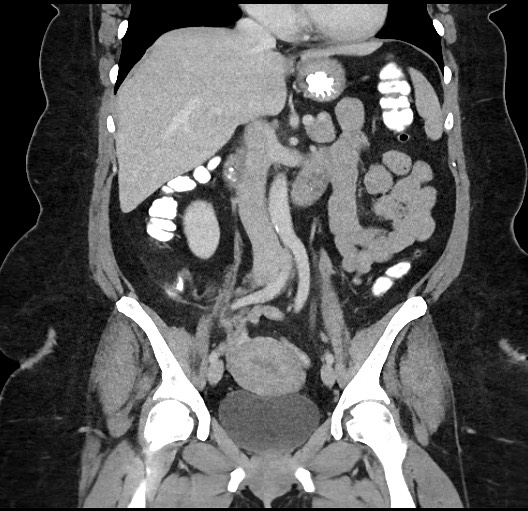 File:Carcinoid tumor - terminal ileum (Radiopaedia 60931-68739 B 43).jpg