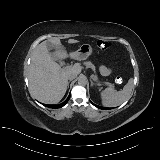 File:Carcinoid tumor - terminal ileum (Radiopaedia 60931-68740 Axial non-contrast 22).jpg