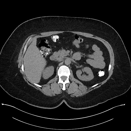 Carcinoid tumor - terminal ileum (Radiopaedia 60931-68740 Axial non-contrast 37).jpg