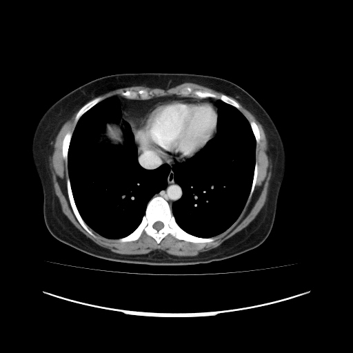 Carcinoma colon - hepatic flexure (Radiopaedia 19461-19493 A 11).jpg