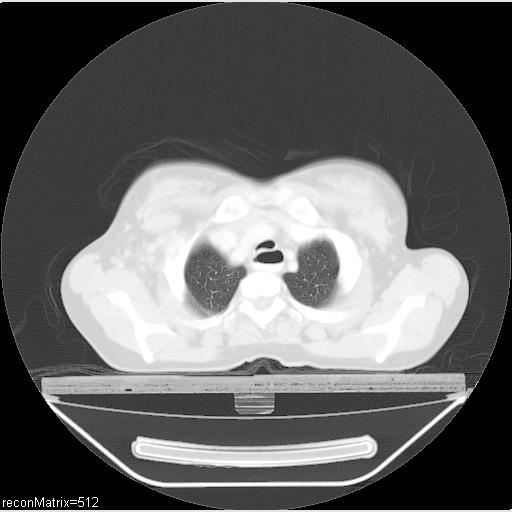File:Carcinoma of esophagus (Radiopaedia 27356-27550 Axial lung window 28).jpg