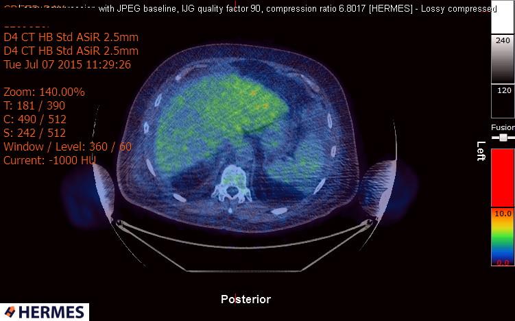 File:Cardiac lymphoma (Radiopaedia 38690-40871 Integrated PET-CT 22).jpg