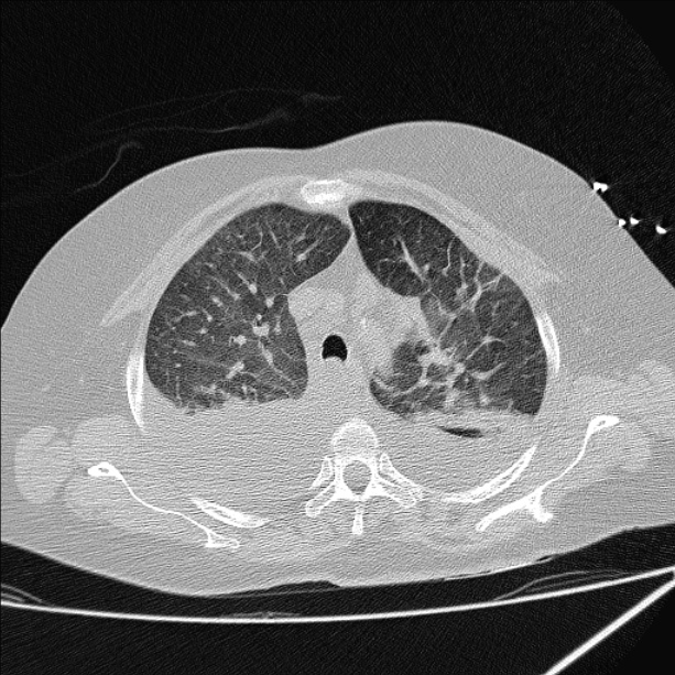 Cardiogenic pulmonary edema (Radiopaedia 29213-29609 Axial lung window 23).jpg