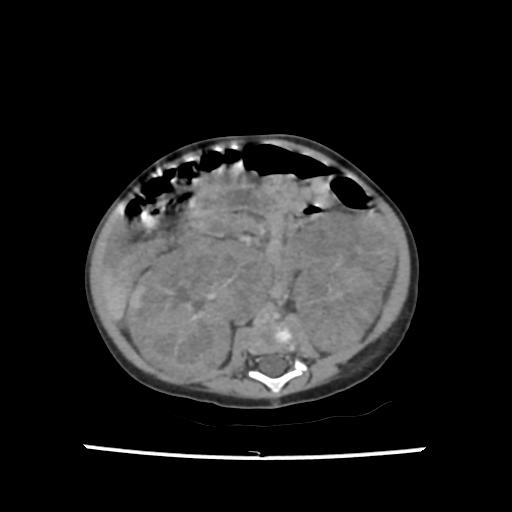 Caroli disease with autosomal recessive polycystic kidney disease (ARPKD) (Radiopaedia 89651-106703 B 131).jpg