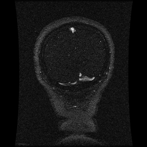 Carotid arterial dissection with acute cerebral infarction (Radiopaedia 26636-26784 MRV 45).jpg
