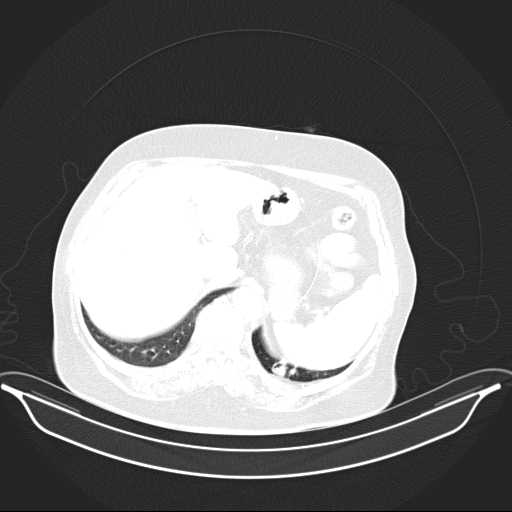 File:Carotid body tumor (Radiopaedia 21021-20948 Axial lung window 44).jpg