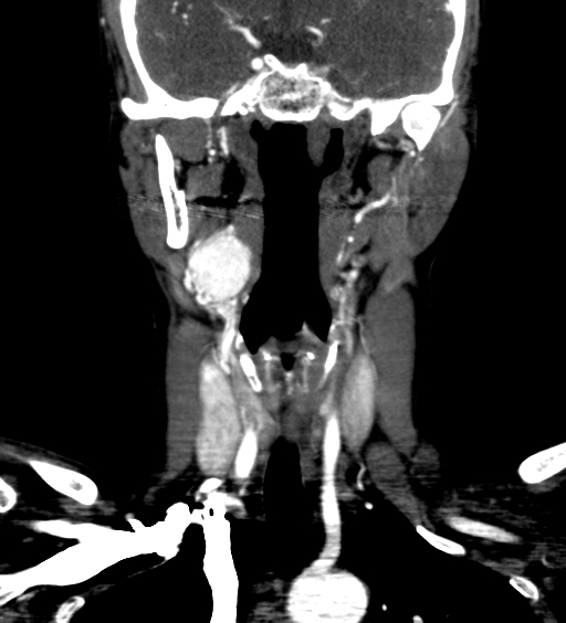 Carotid body tumor (Radiopaedia 39845-42300 C 20).jpg