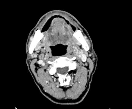 Carotid body tumor (Radiopaedia 61750-69757 Axial Post contrast 36).jpg