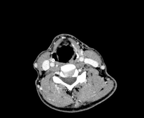 Carotid body tumor (Radiopaedia 61750-69757 Axial Post contrast 70).jpg