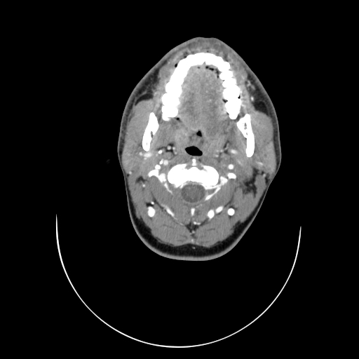 File:Carotid bulb pseudoaneurysm (Radiopaedia 57670-64616 A 16).jpg