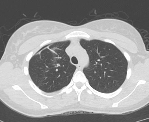 File:Catamenial pneumothorax (Radiopaedia 54382-60600 Axial 33).png