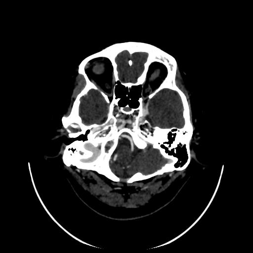 Cavernoma with developmental venous anomaly (Radiopaedia 22470-22506 C 17).jpg