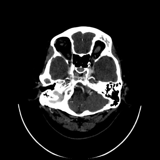 File:Cavernoma with developmental venous anomaly (Radiopaedia 22470-22506 C 19).jpg