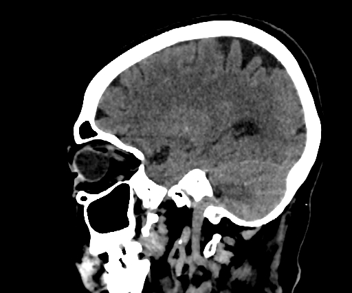 Cavernous hemangioma of the cerebellar falx (Radiopaedia 73025-83723 B 226).jpg