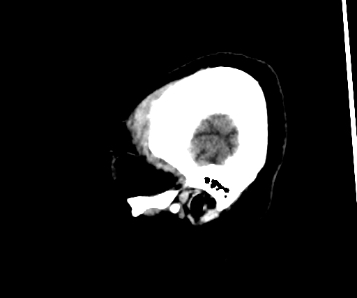 Cavernous hemangioma of the cerebellar falx (Radiopaedia 73025-83723 B 300).jpg