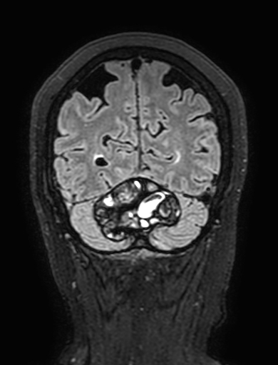 Cavernous hemangioma of the cerebellar falx (Radiopaedia 73025-83724 Coronal FLAIR 290).jpg