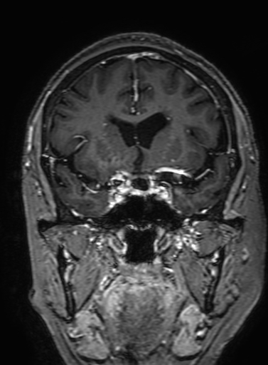 Cavernous hemangioma of the cerebellar falx (Radiopaedia 73025-83724 Coronal T1 C+ 139).jpg