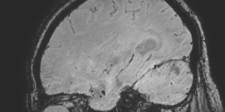 Cavernous hemangioma of the cerebellar falx (Radiopaedia 73025-83724 Sagittal BOLD 57).jpg