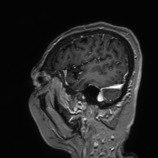 File:Cavernous hemangioma of the cerebellar falx (Radiopaedia 73025-83724 Sagittal T1 C+ 36).jpg