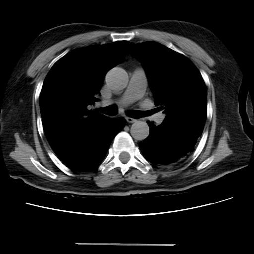 Cavitating pulmonary metastases (Radiopaedia 89545-106544 Axial non-contrast 25).jpg