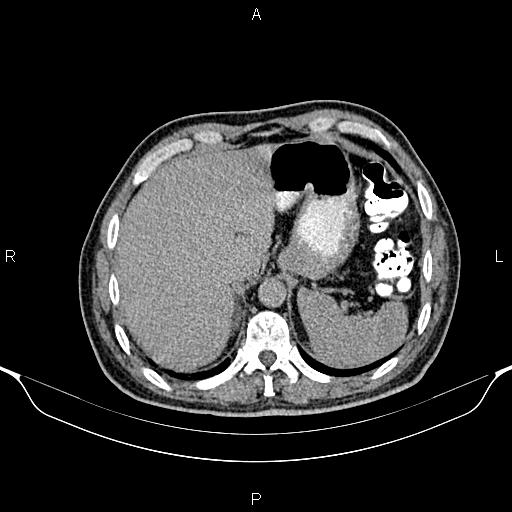 Cecal adenocarcinoma (Radiopaedia 85324-100916 Axial C+ delayed 18).jpg