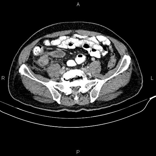 File:Cecal cancer with appendiceal mucocele (Radiopaedia 91080-108651 B 76).jpg